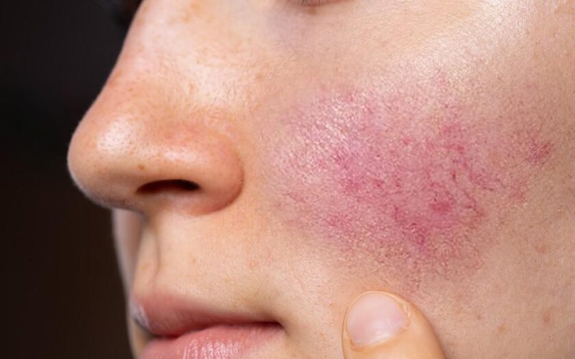 When you should be worried about your rosy cheeks: Experts highlight signs of rosacea