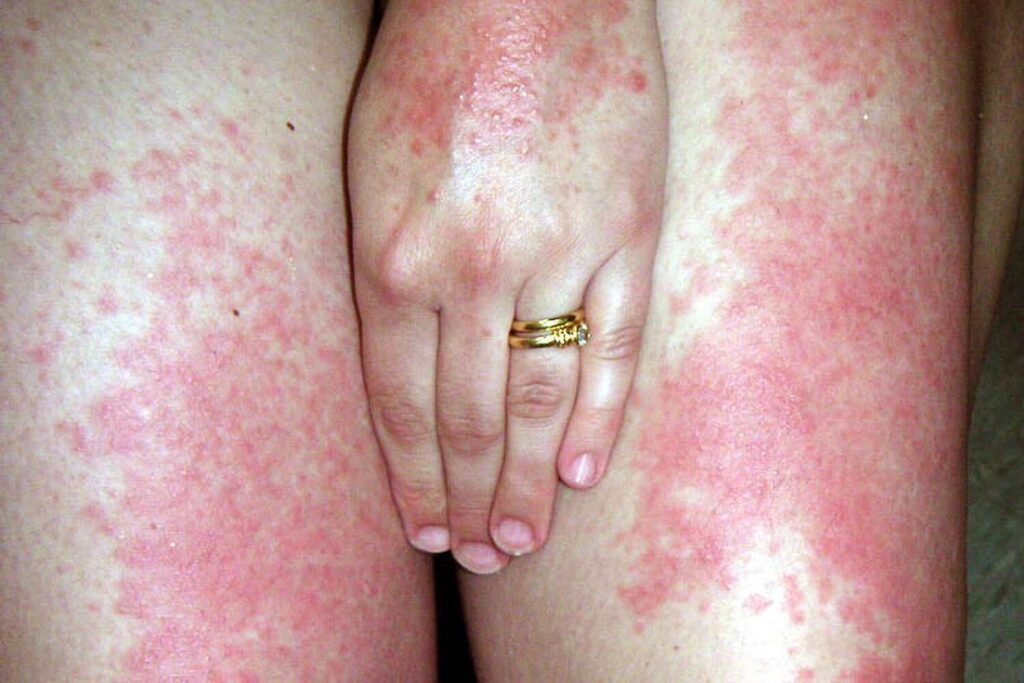 sun allergy